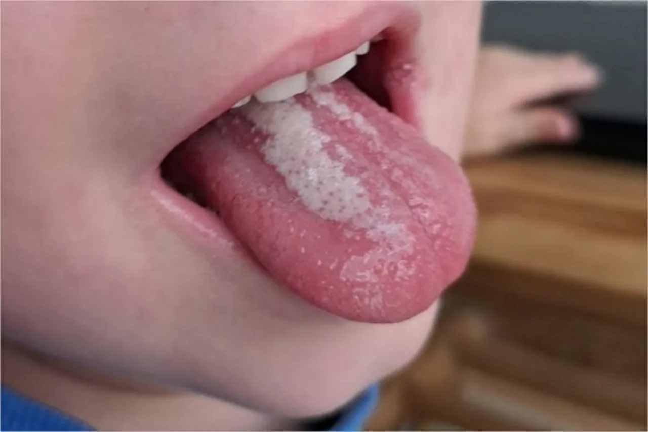 Wysypka szkarlatynowa na ciele dziecka