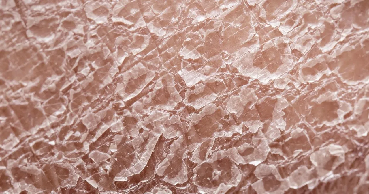 Skutki uboczne metotreksatu jelita