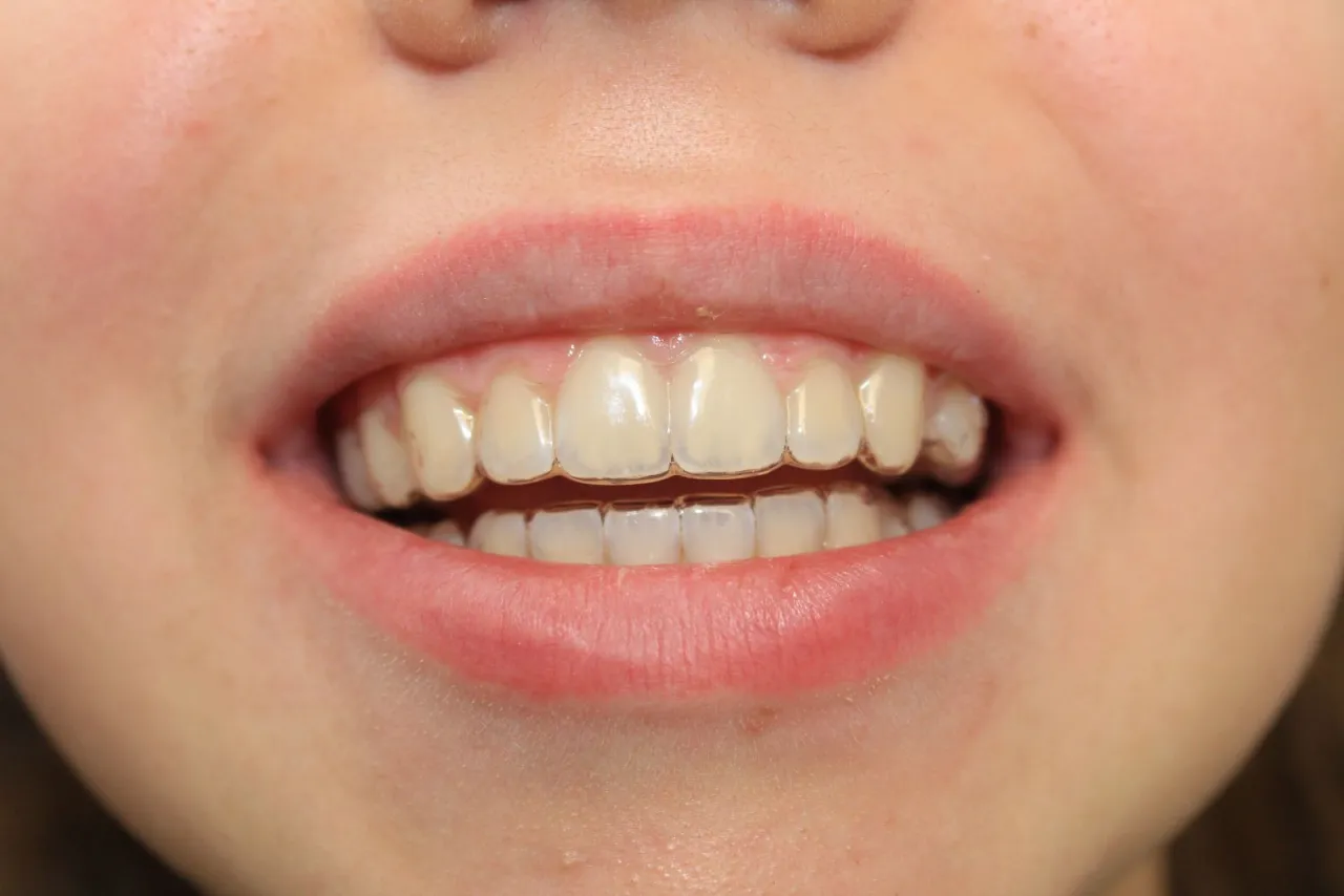 przezroczyste nakładki ortodontyczne invisalign na zębach