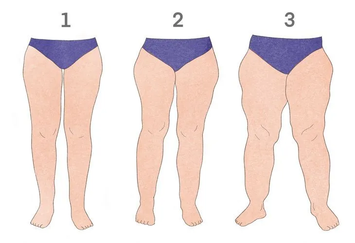 Rodzaje cellulitu, obrzęki n&oacute;g