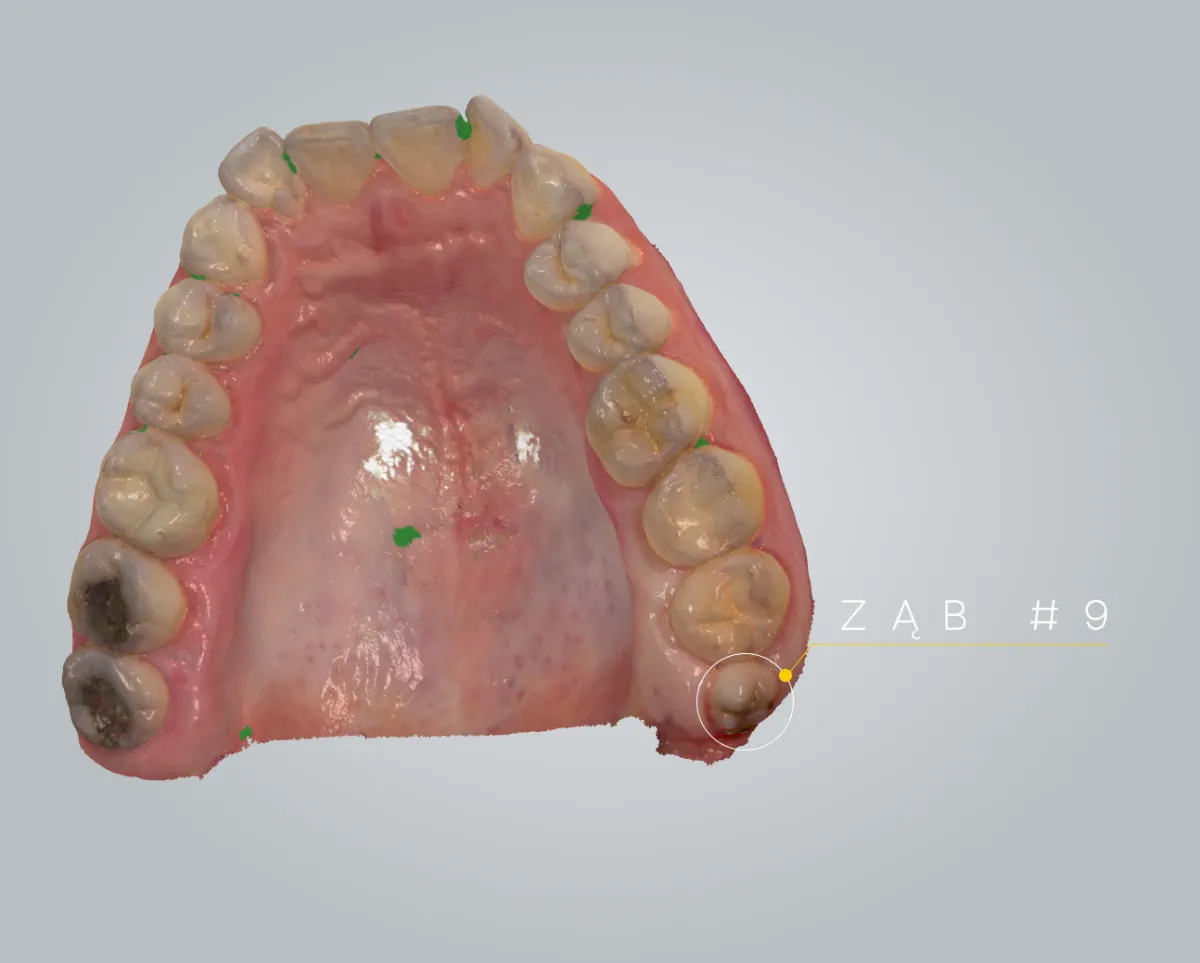 różne rodzaje zębów rosnących na dziąśle, ząb nadliczbowy, ząb mleczny nie wypadł