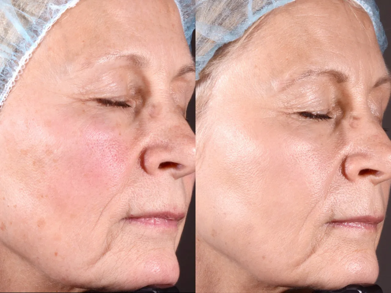 zabiegi gabinetowe cera 35+ przed po