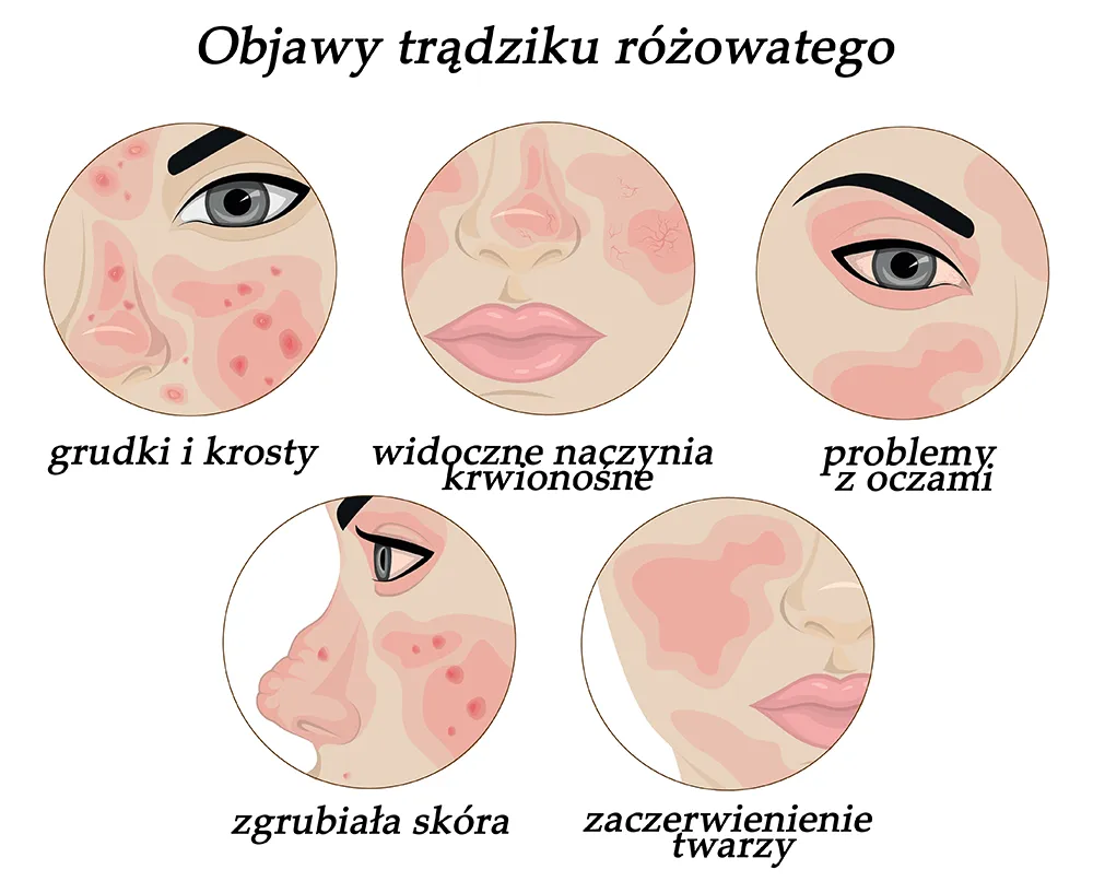 trądzik różowaty objawy etapy rozwoju