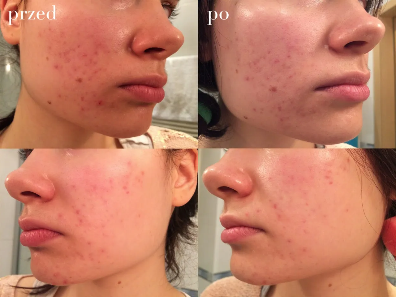 kwas glikolowy przed po, cera trądzikowa, cera dojrzała
