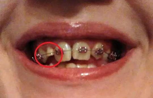 przetrwały ząb mleczny i ząb stały obok