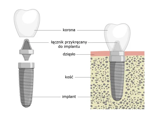 implant zęba schemat