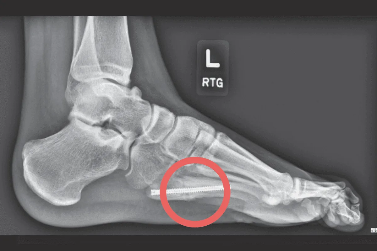 fizjoterapia po złamaniu kości piętowej