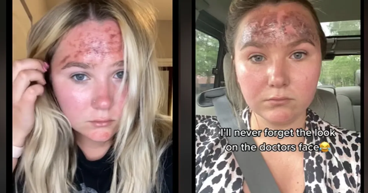 krem z filtrem SPF na twarzy po zabiegu