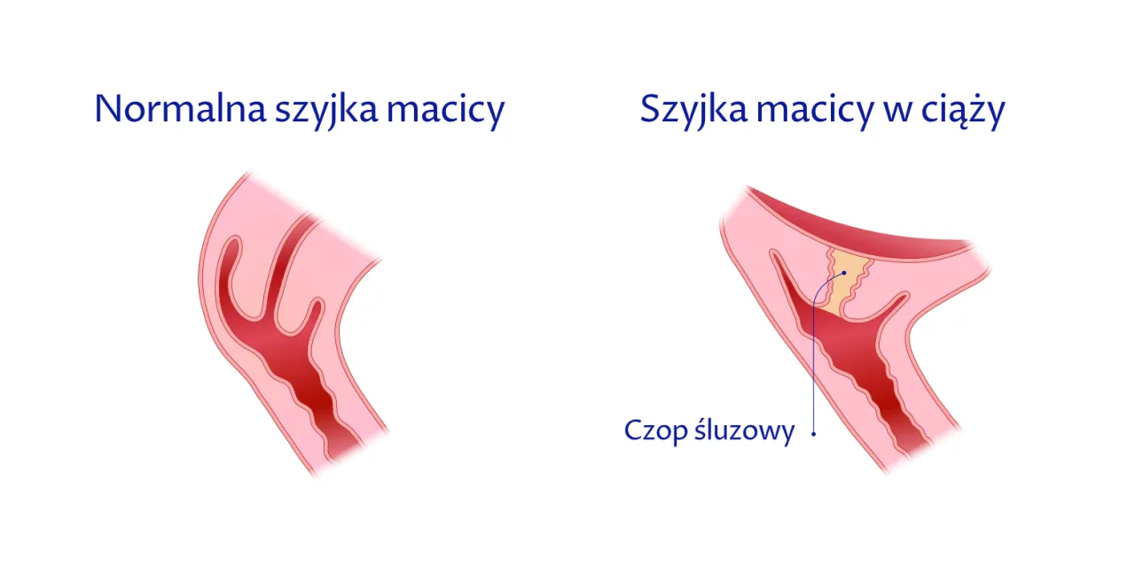 rozwieranie i skracanie szyjki macicy grafika