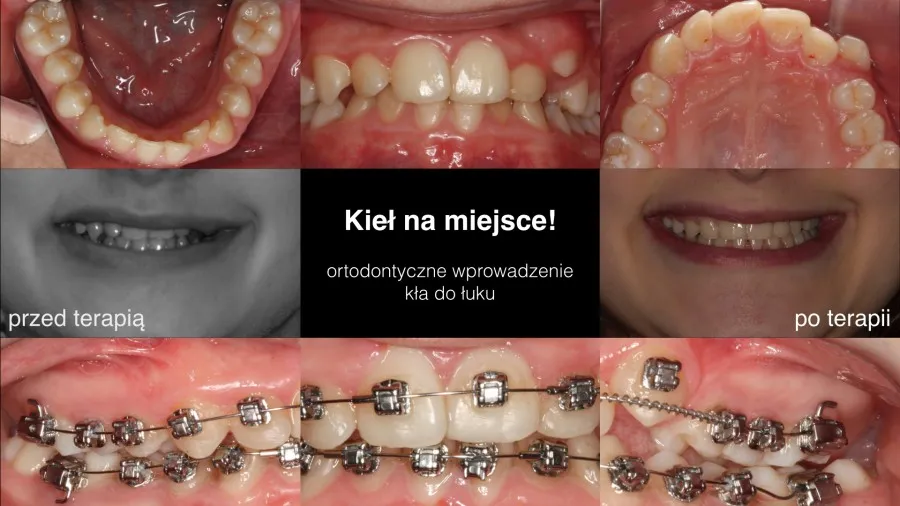 Aparat ortodontyczny na g&oacute;rny łuk zębowy przed i po