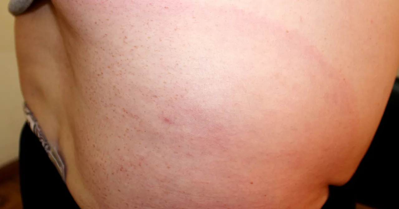 por&oacute;wnanie rumień wędrujący odczyn alergiczny po kleszczu