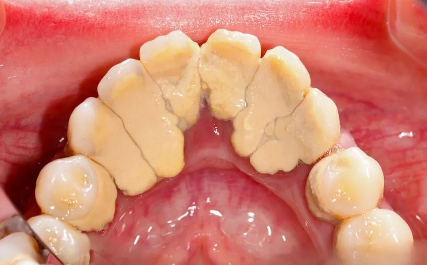 dentysta dziecięcy usuwający osad z zębów