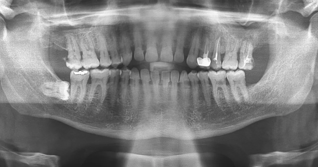 przykładowy pantomogram zęb&oacute;w opis struktur