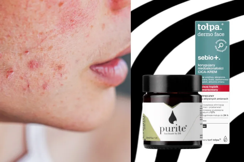 kremy na trądzik por&oacute;wnanie