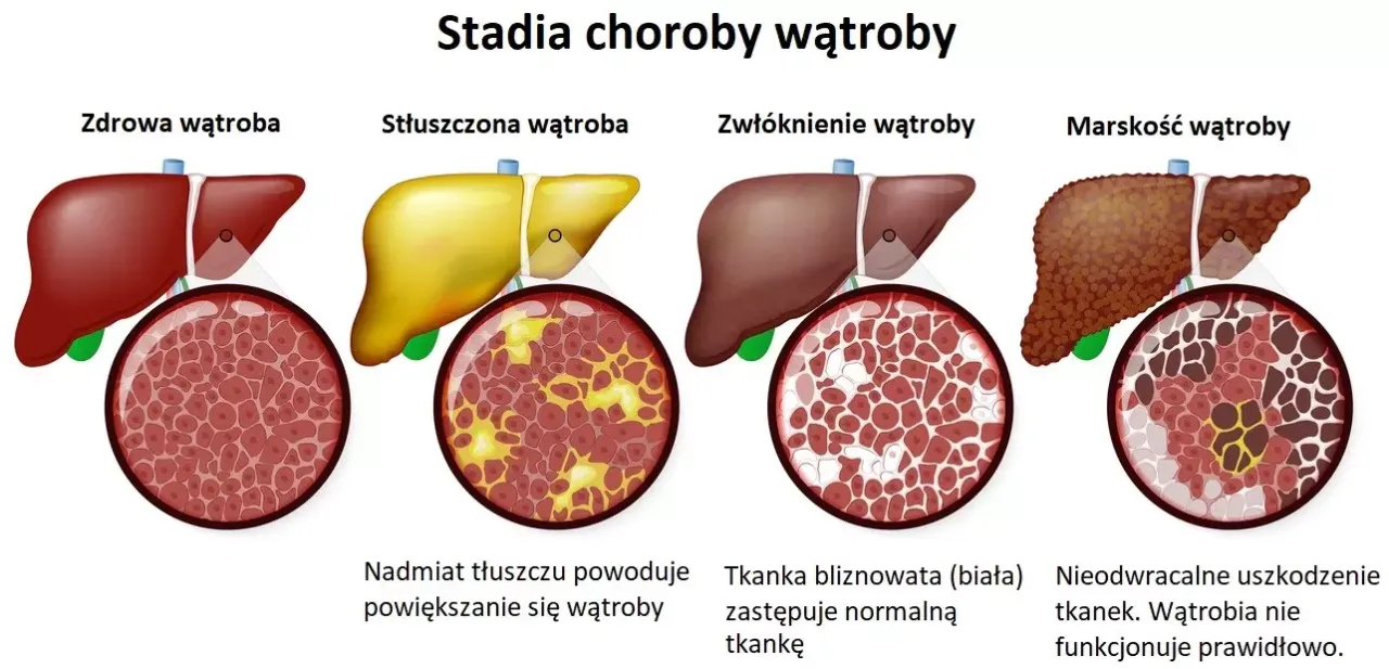 schemat chorób wątroby