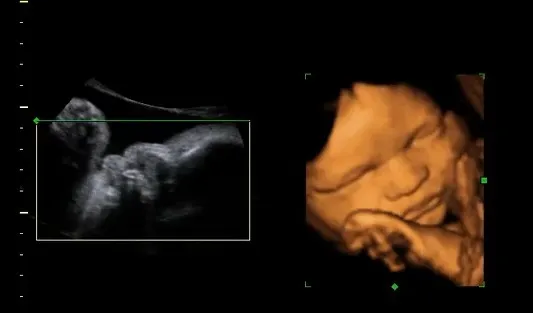 dziecko w 31 tygodniu ciąży usg