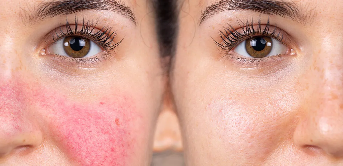 laserowe zamykanie naczynek przed i po