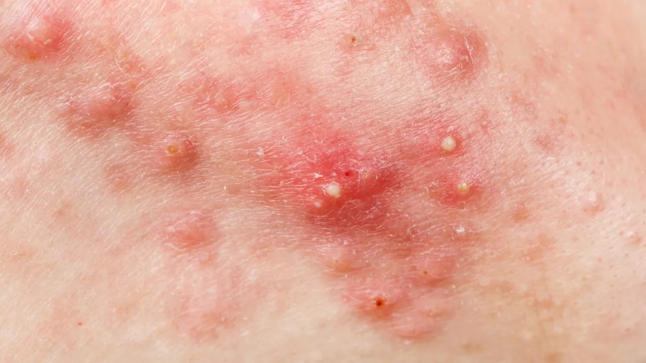 nie wyciskać pryszcza, zakaz wyciskania trądziku, konsekwencje wyciskania