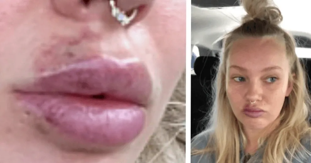 martwica ust objawy chronologia