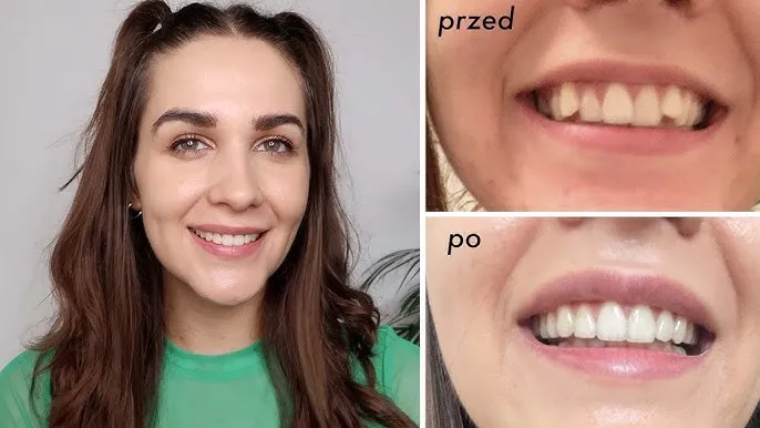 invisalign na zębach przed i po