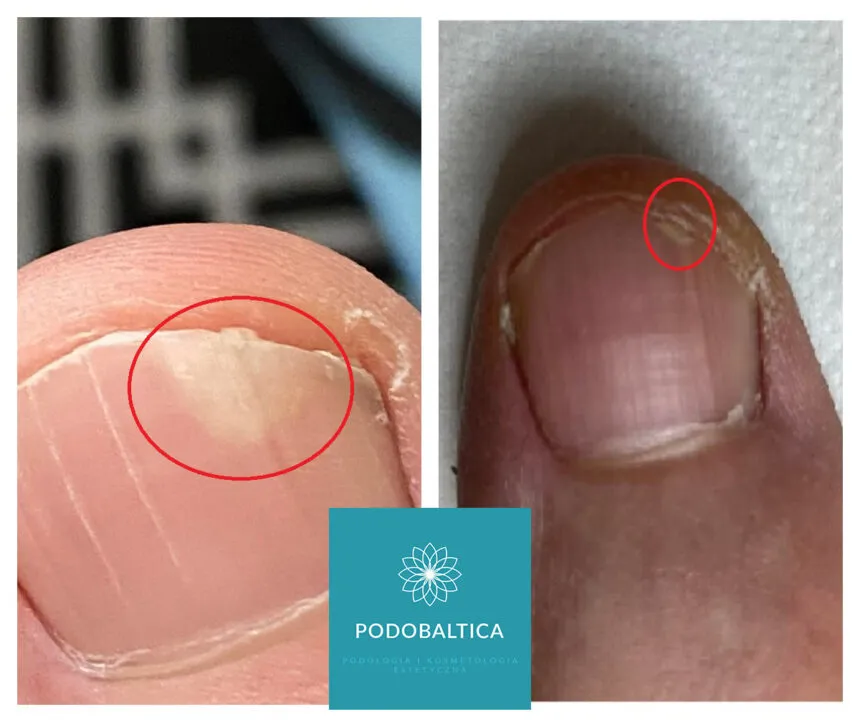 Zdjęcie Skuteczne sposoby na leczenie onycholizy paznokcia i zapobieganie jej