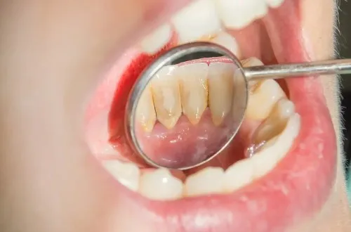 Zdjęcie Jak usunąć kamień nazębny bez dentysty - skuteczne metody i pułapki