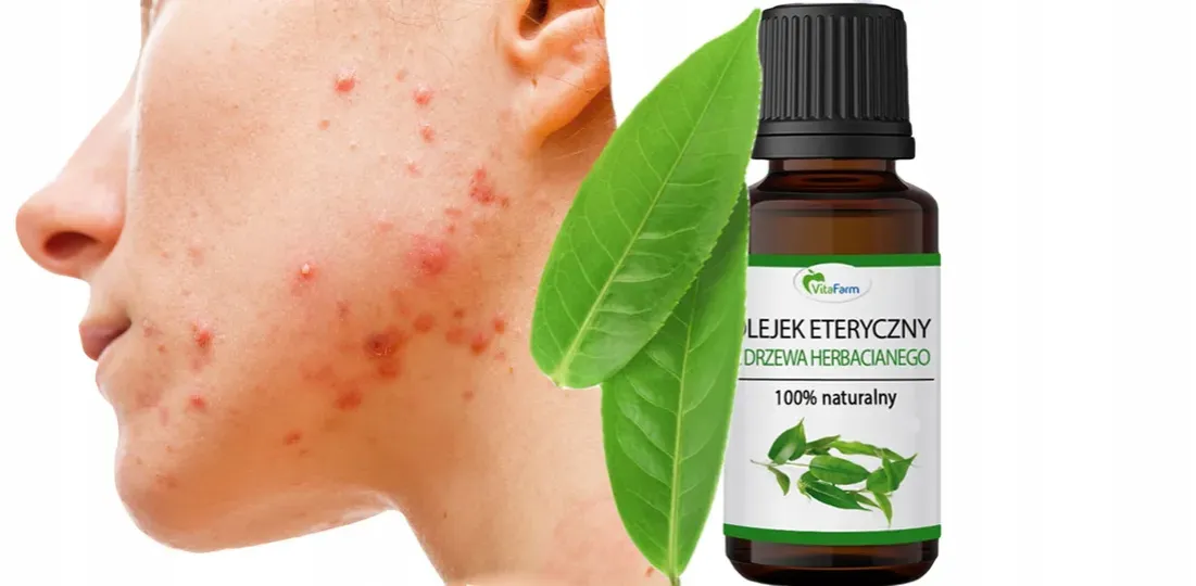 Olejek z drzewa herbacianego glinka zielona cynk na pryszcze