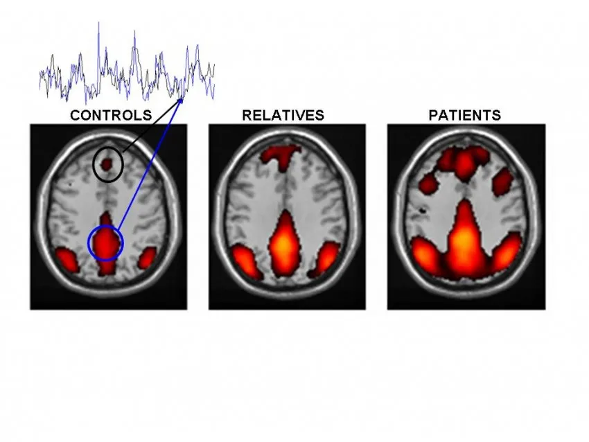 porównanie mózgu DID i schizofrenia lub symbolizujące różnice w postrzeganiu