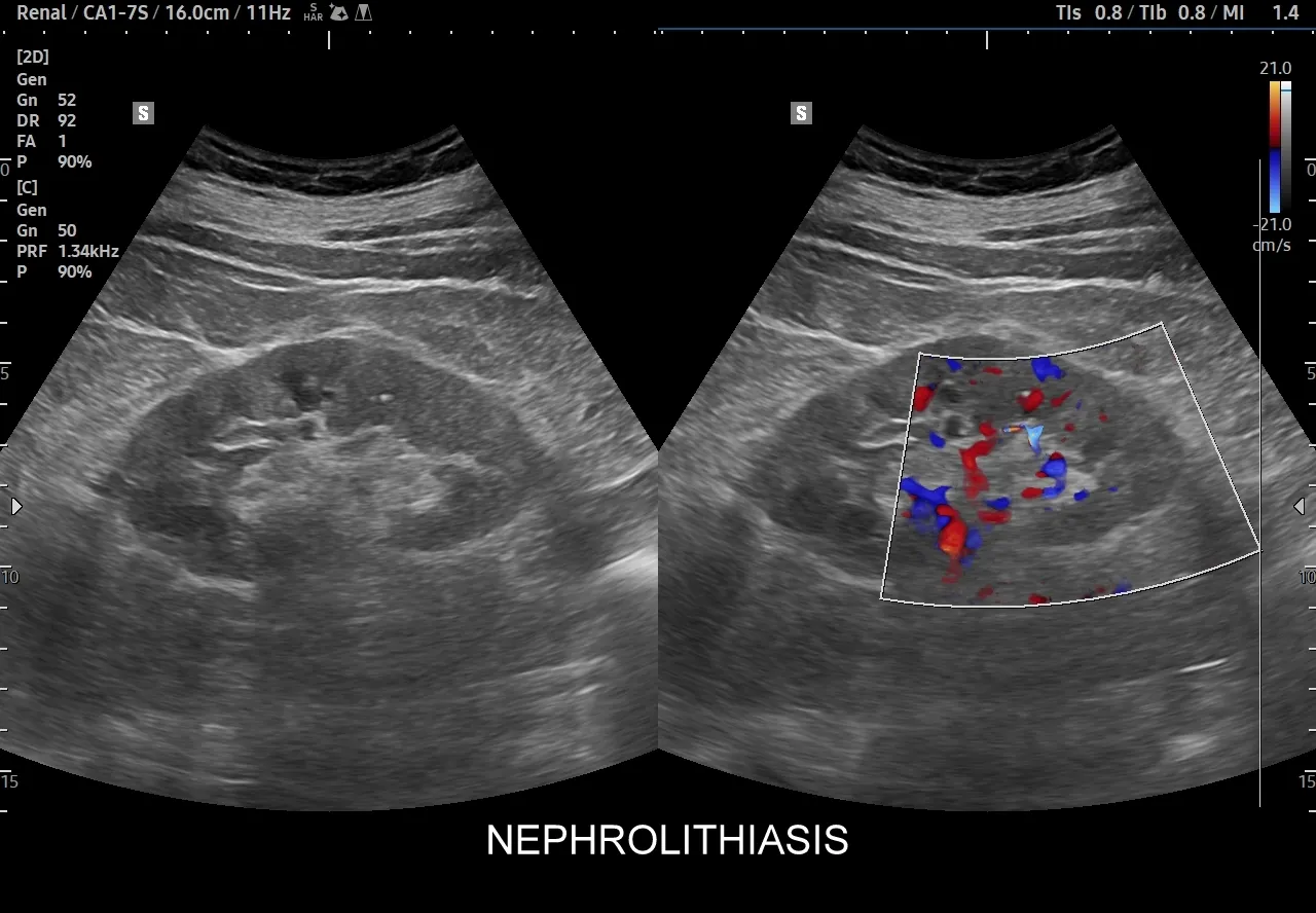 Kamica nerkowa USG
