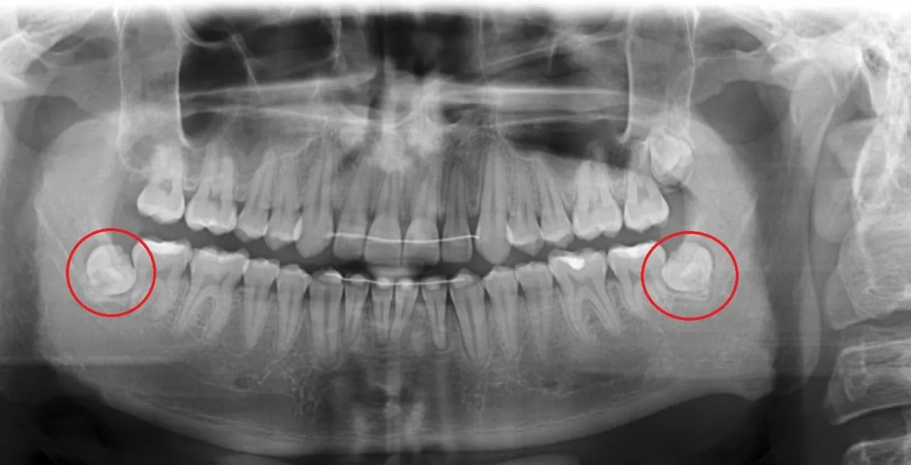pantomogram zęb&oacute;w mądrości