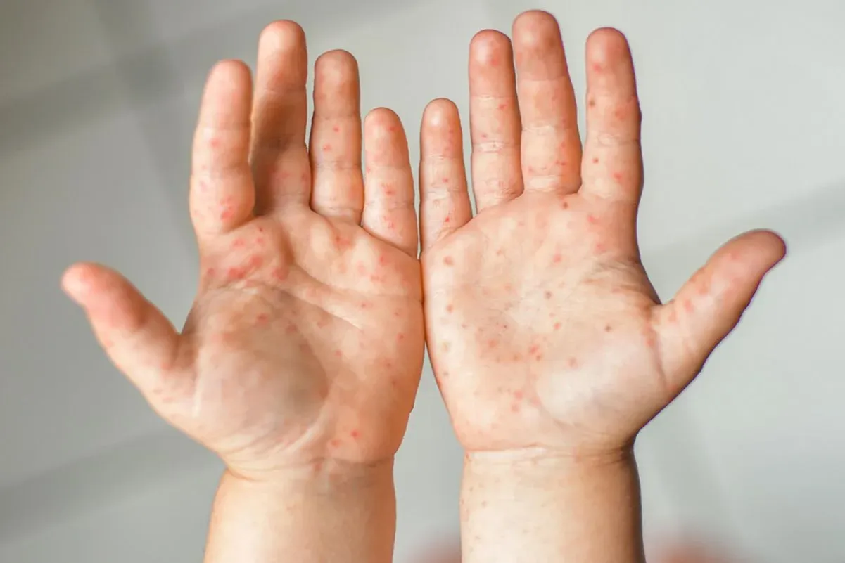 Dłonie dziecka pokryte czerwonymi kropkami, objawem choroby dłoni, stóp i jamy ustnej, znanej jako bostonka u dzieci.
