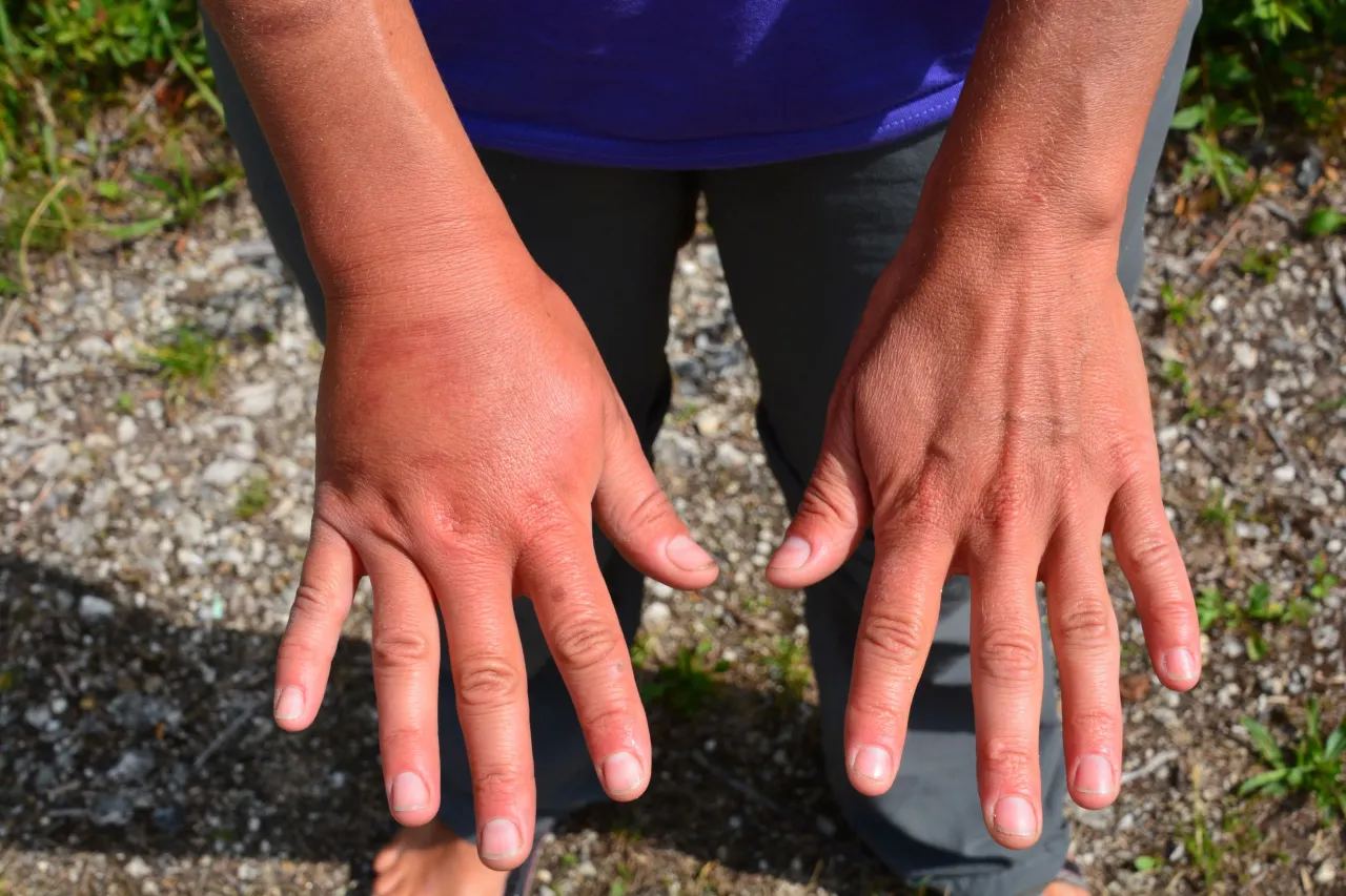 Spuchnięta, zaczerwieniona dłoń po ukąszeniu osy. Zimny okład i leki przeciwhistaminowe to dobre sposoby na złagodzenie objawów.