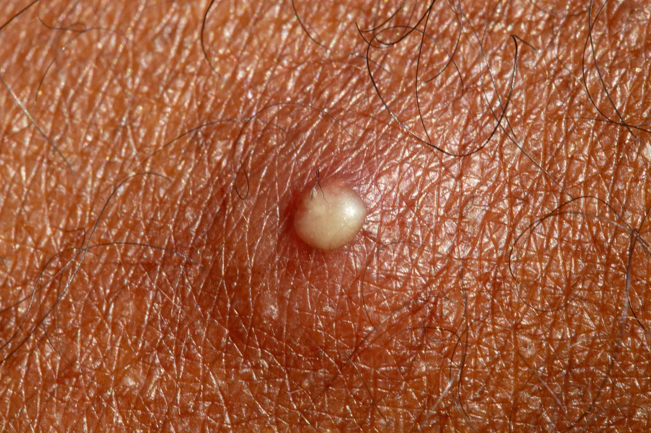 Trądzik czy zapalenie mieszków włosowych?