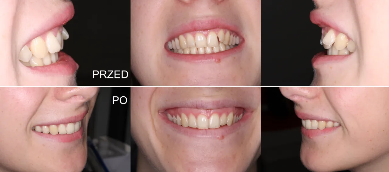 aparat stały metalowy przed i po