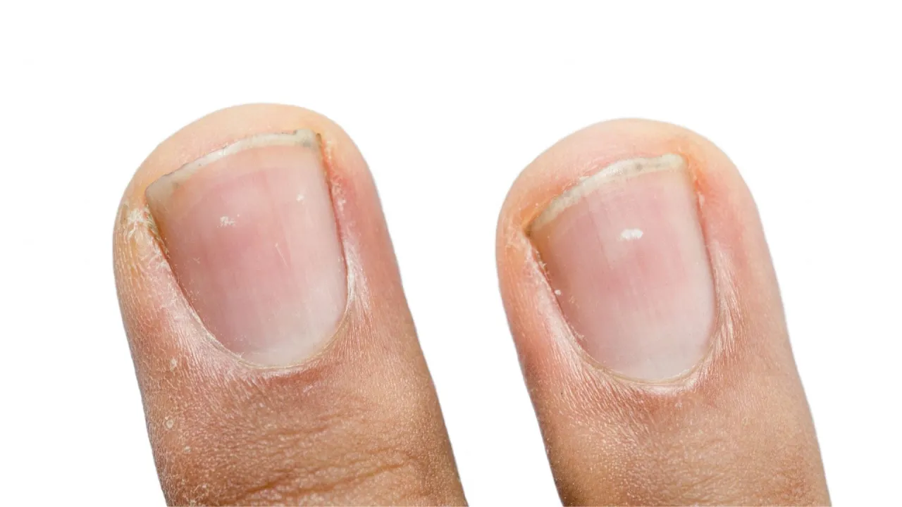 białe plamki na paznokciach urazy