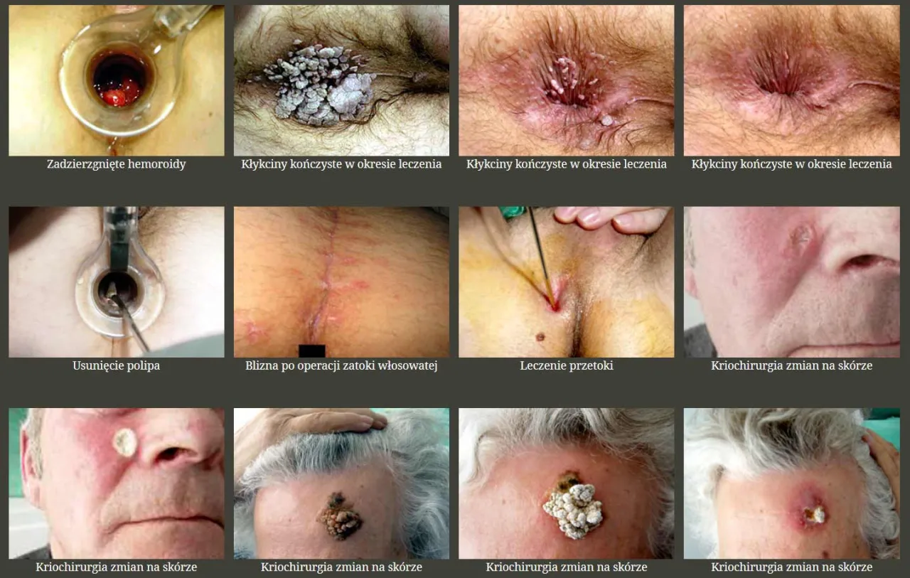 Badanie anoskopia rektoskopia