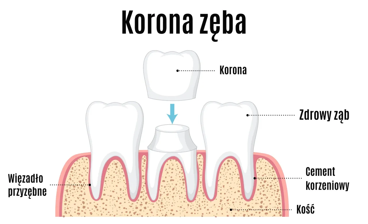 rodzaje koron zębowych porównanie