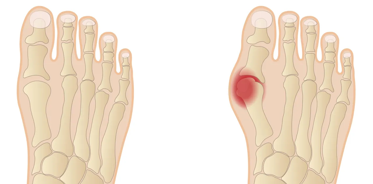 Por&oacute;wnanie st&oacute;p: zdrowa i z haluksami. Obrazek pokazuje, dlaczego robią się haluksy, uwidaczniając deformację kości.