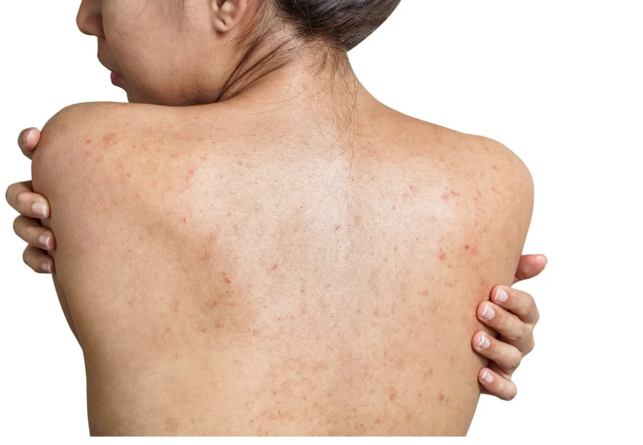 Przyczyny trądziku na plecach