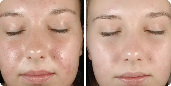 mezoterapia igłowa twarzy, peeling chemiczny zabieg, oxybrazja przed i po