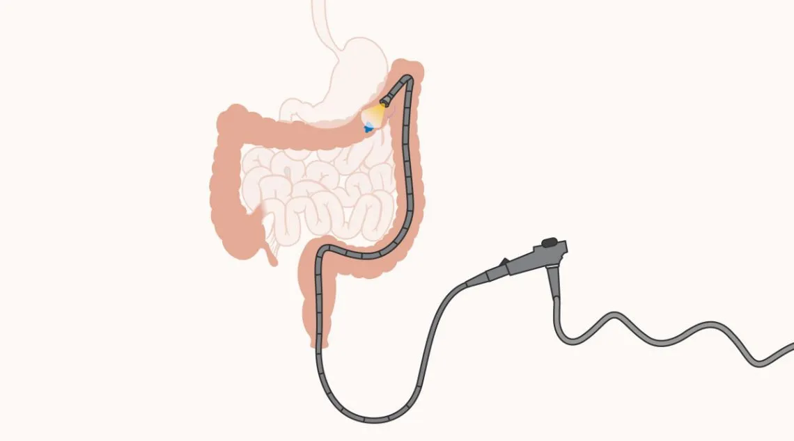 Kolonoskopia jako złoty standard diagnostyki
