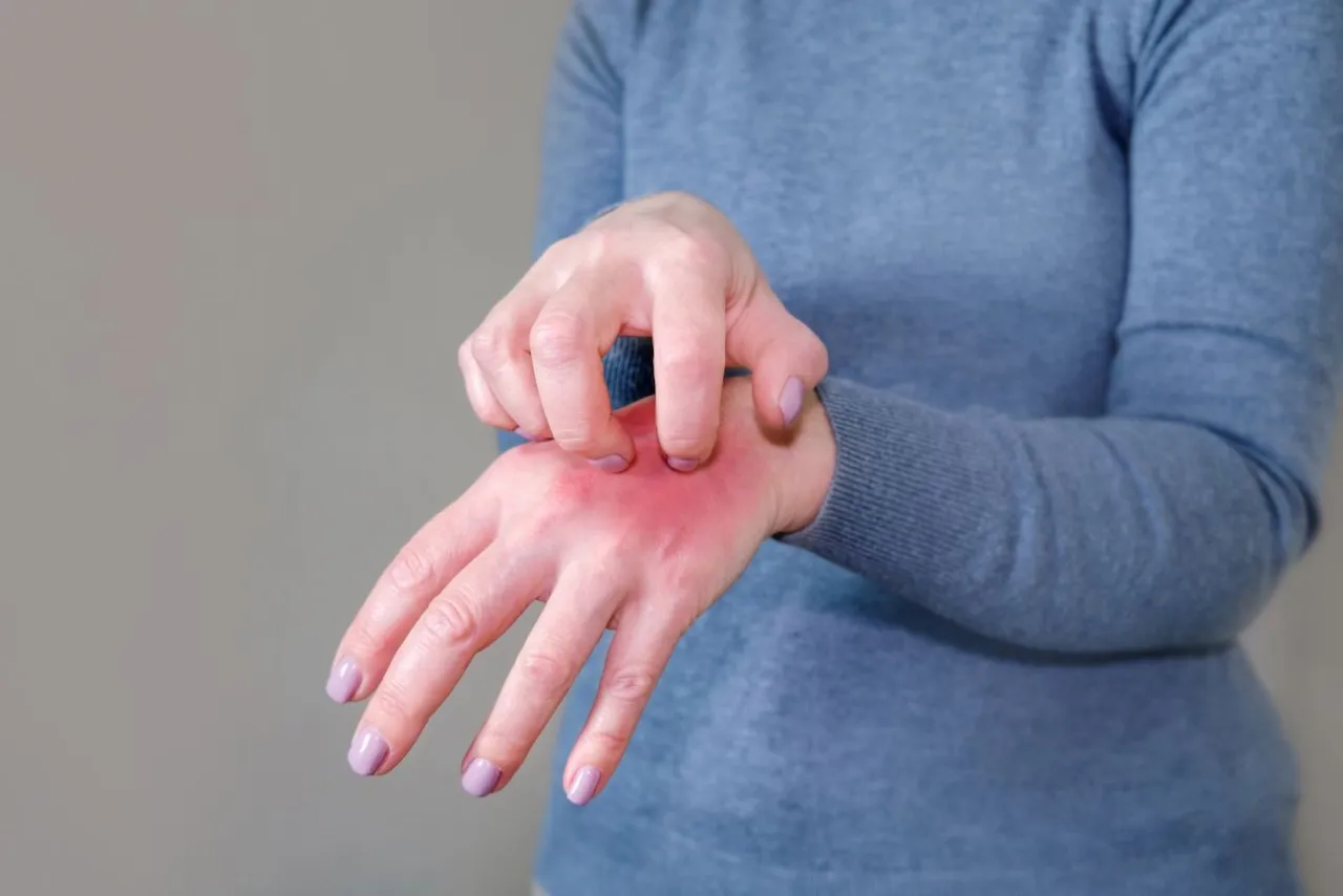 alergia na hybrydę vs akryl reakcja krzyżowa