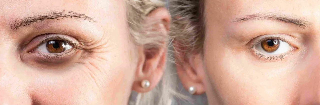 bezpieczny zabieg botoksu klinika