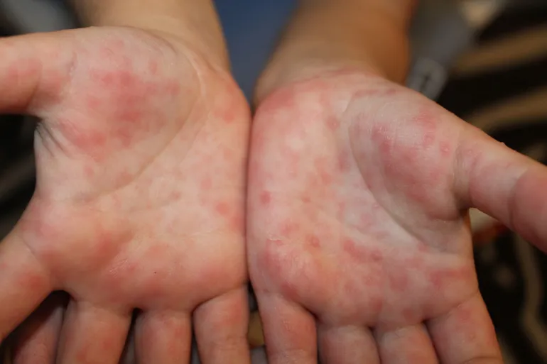 leki na bostonkę dla dzieci