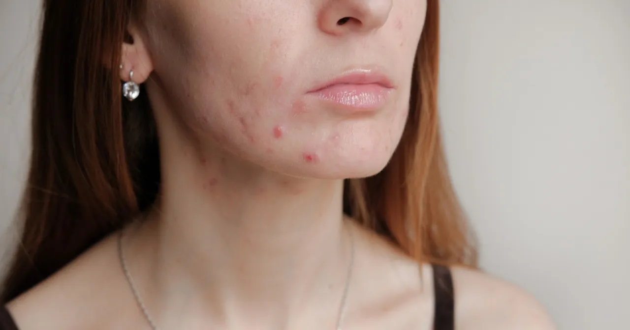 Nastolatek z trądzikiem młodzieńczym