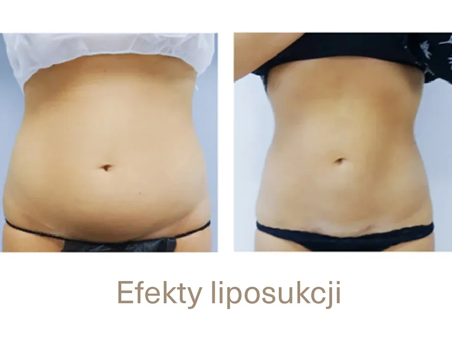 Liposukcja przed i po efekty