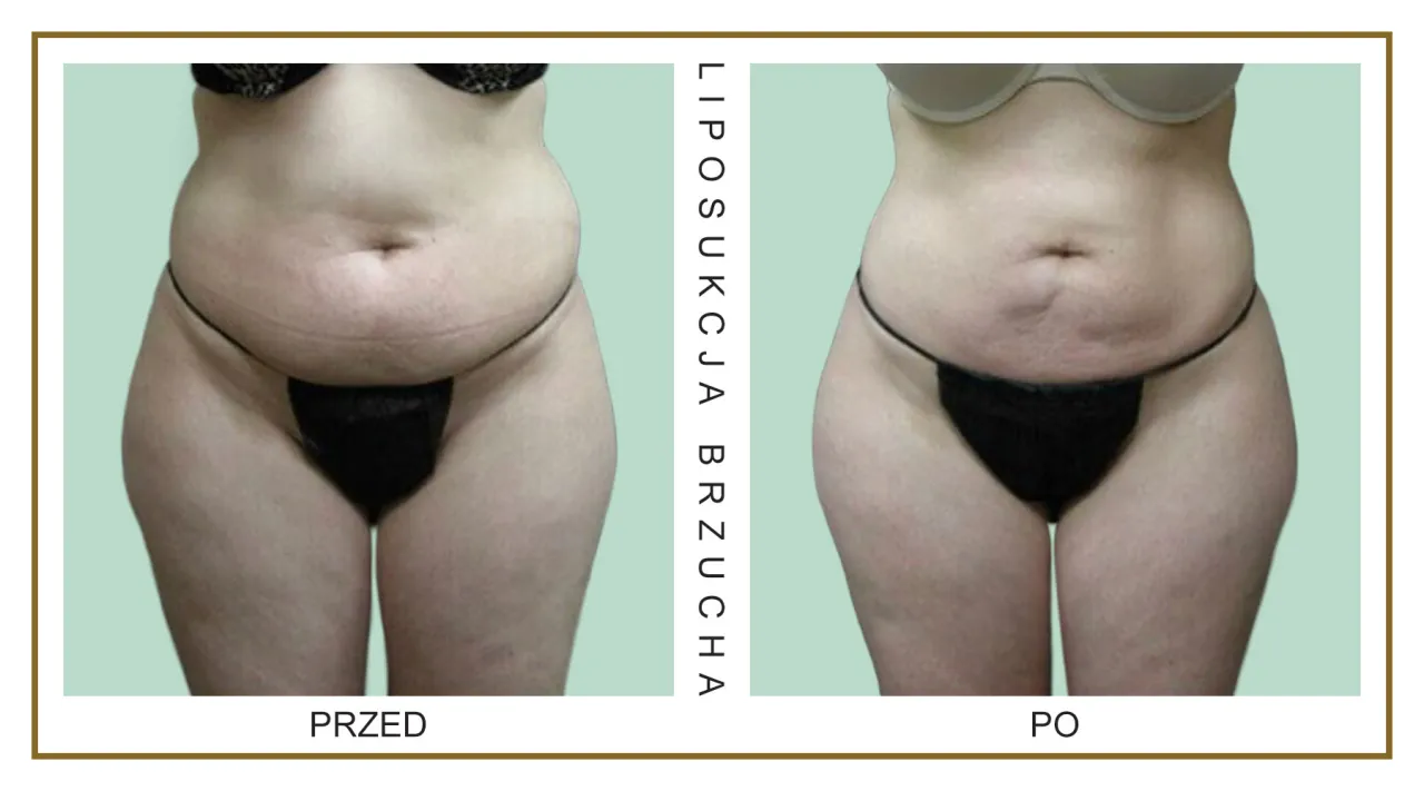 porównanie metod liposukcji brzucha grafika