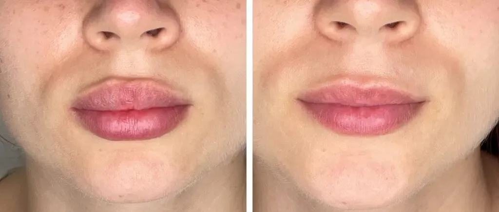 zabieg rozpuszczania kwasu hialuronowego hialuronidazą przed i po