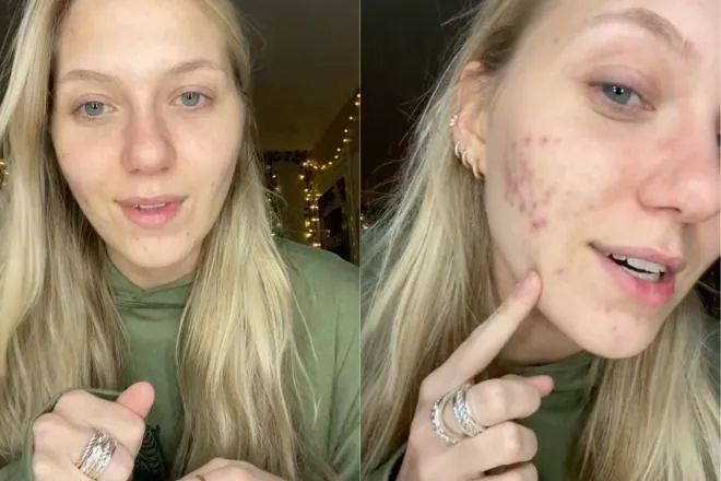 plasterki hydrokoloidowe na pryszcze przed i po
