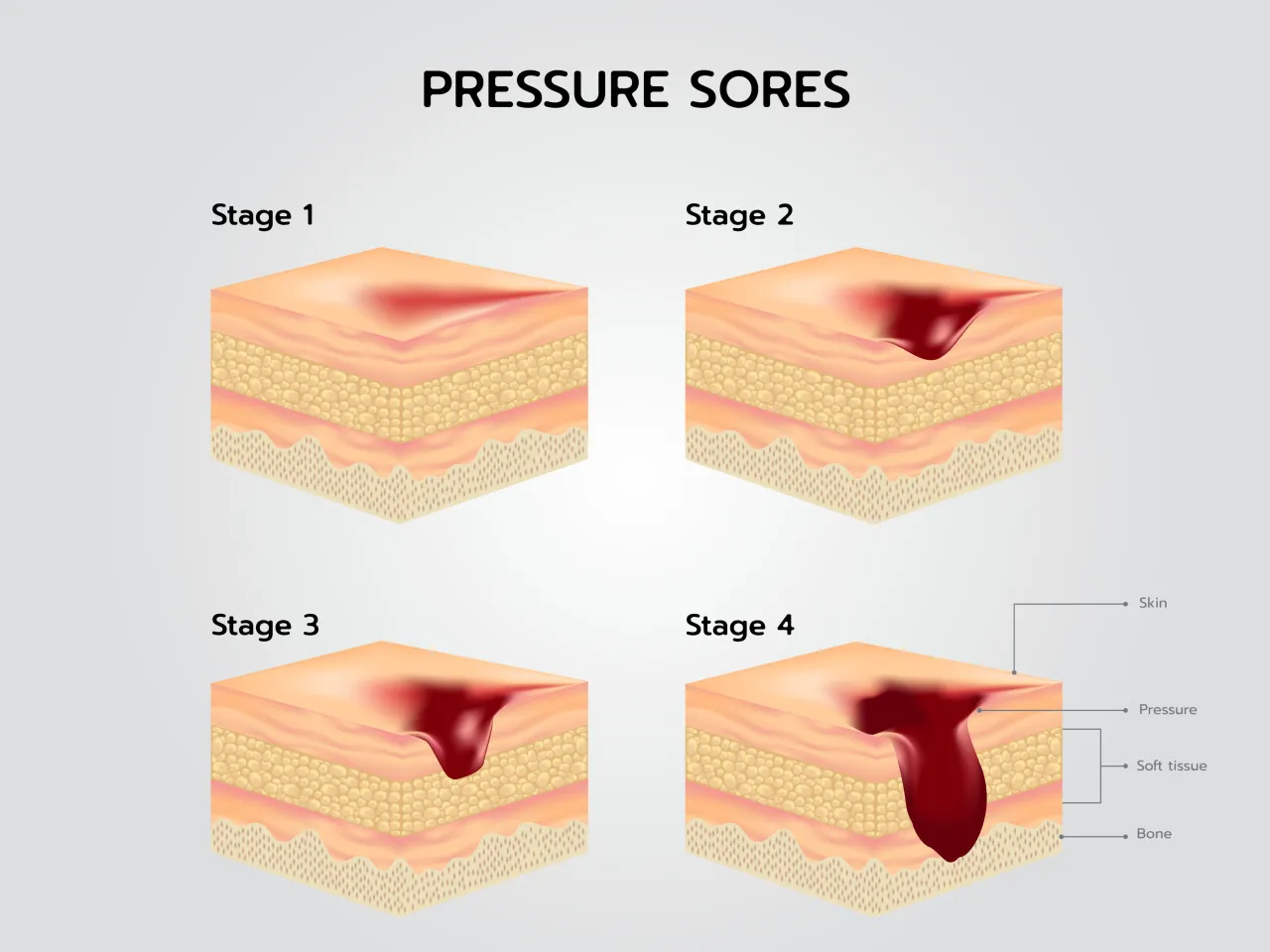 pielęgnacja sk&oacute;ry profilaktyka odleżyn